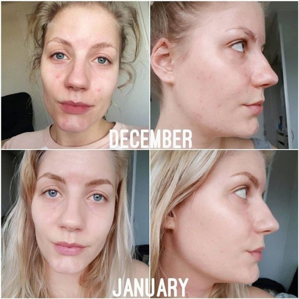 5cf028a1af62bThe_Ordinary_Niacinamide_10_Zinc_1_30ML_Face_Serum_Reduce_Acne_Pigmentation_Facial_Whitening_Liquid_Serum_70271.1544521880-1000x1000.jpg