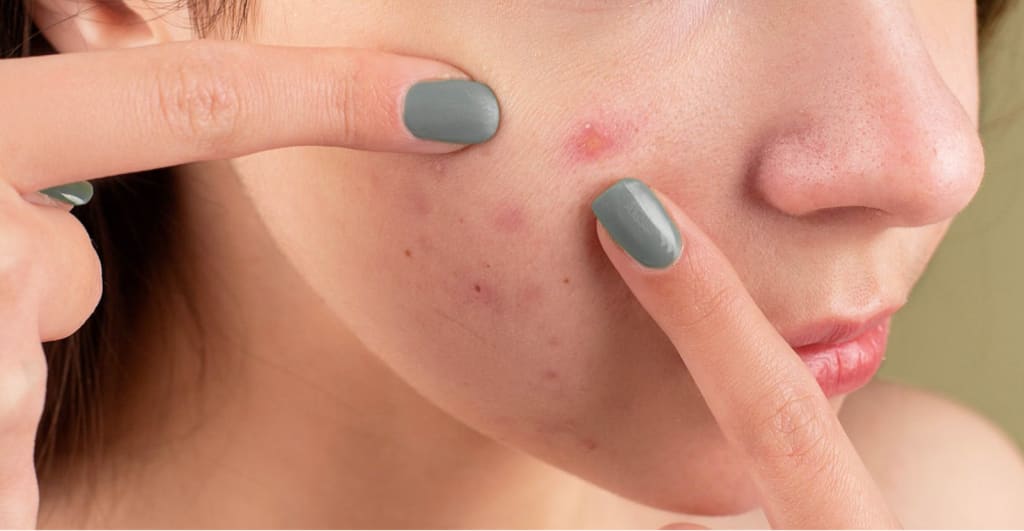 6 Best Acne Skin Cleansers Malaysia 2022 Doctor Picks