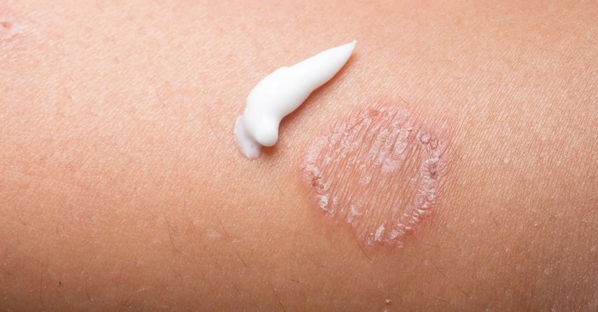 antifungal cream for armpits