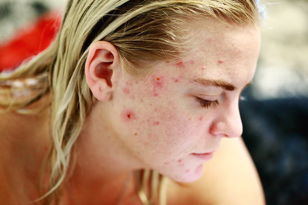 best-acne-product-treatment-malaysia.jpg