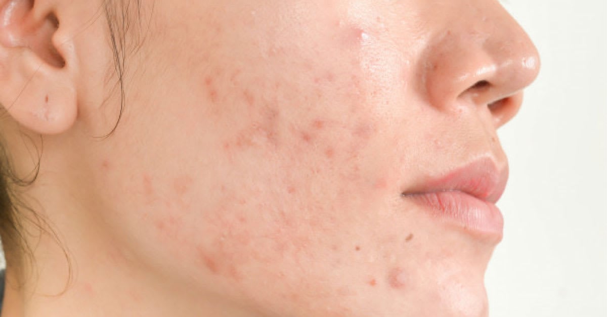 best-acne-scar-treatment-product-malaysia.jpg