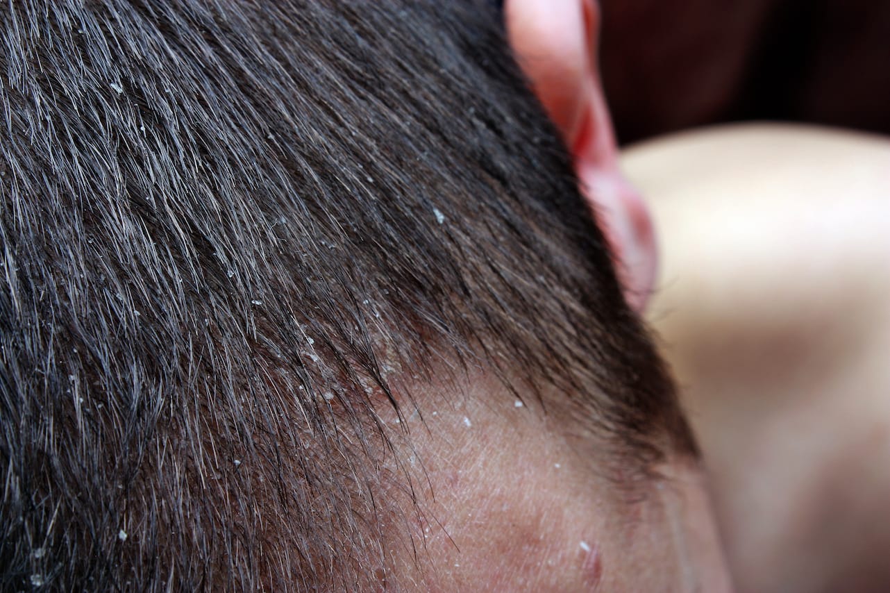 Itchy Scalp Causes and Treatments