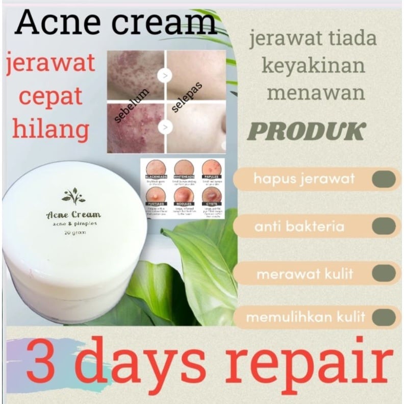 Acne Cream Acne & Pimple
