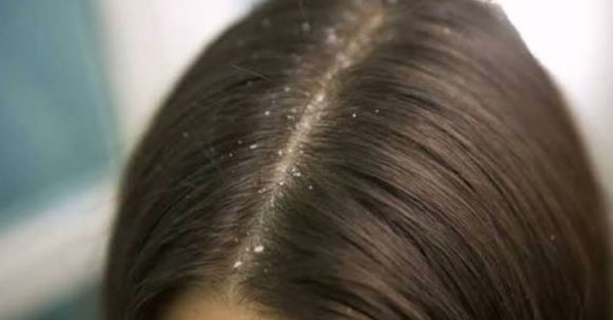 8 Best Dandruff Shampoos In The Philippines For Flake Free Hair