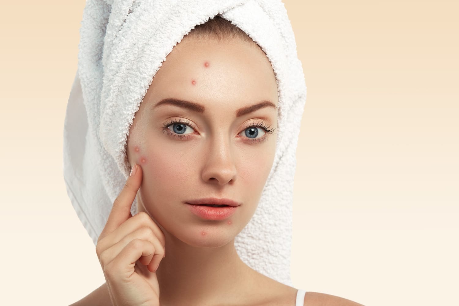 closeup-young-woman-with-towel-head-pimples-face (1).jpg