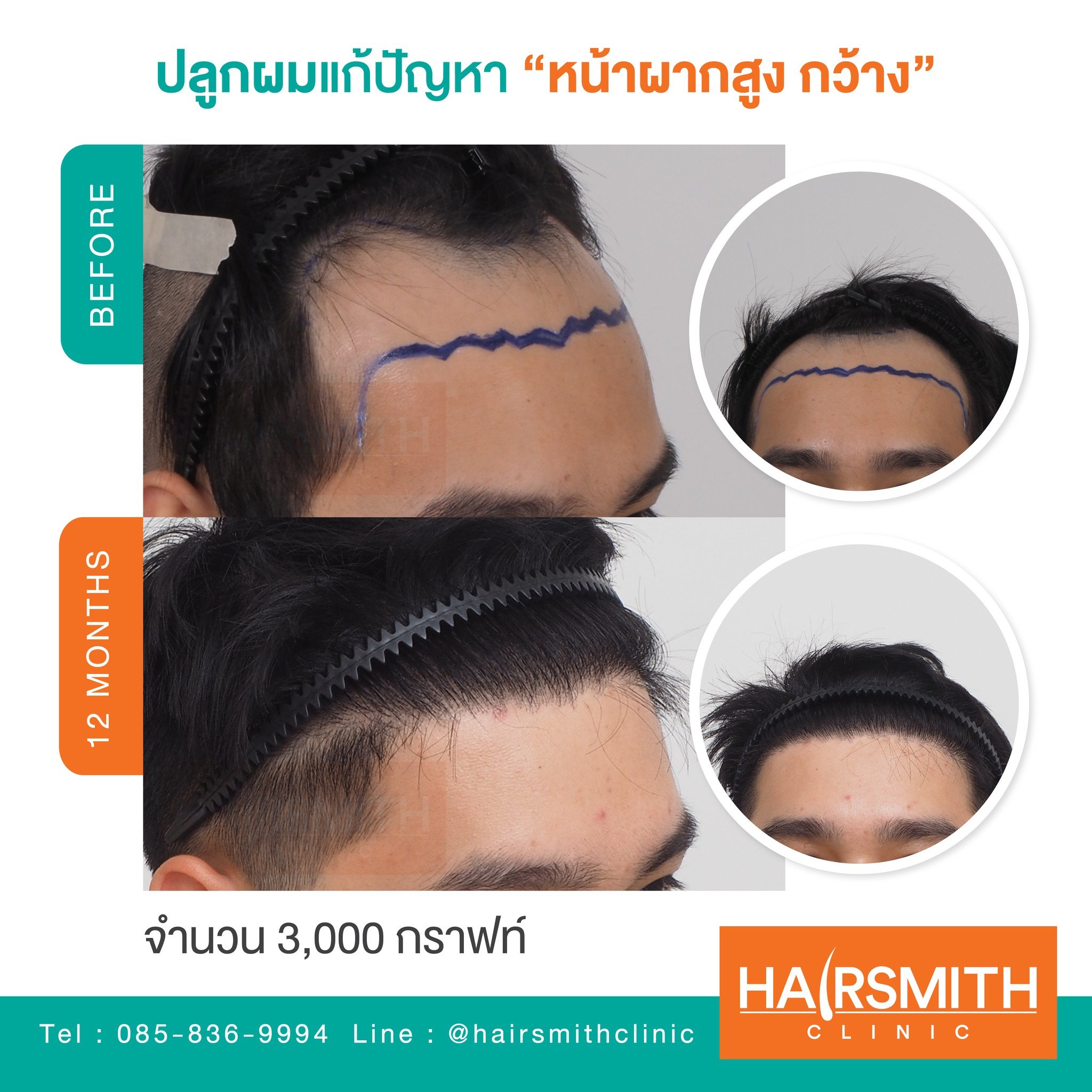 คลินิกปลูกผม : Hairsmith Clinic